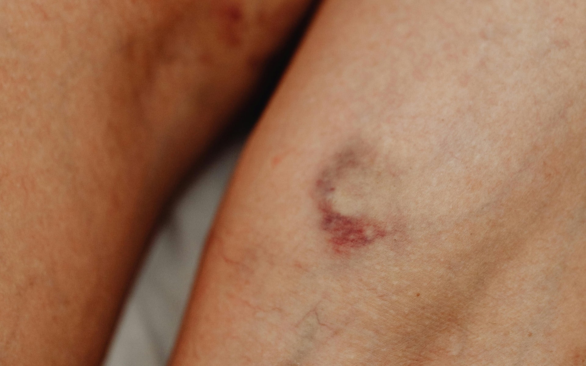 These Vitamins Can Help With Bruising